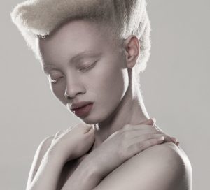 Zimbabwe Sets Milestone in Africa for Albinism